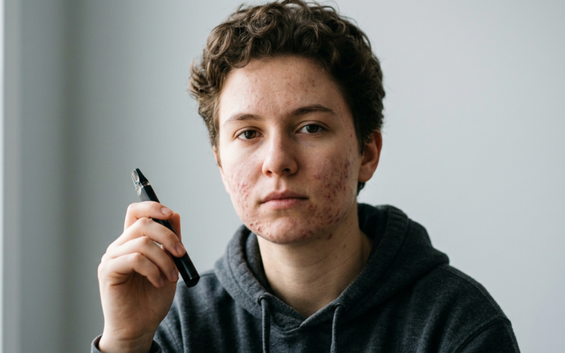 Does Vaping Cause Acne