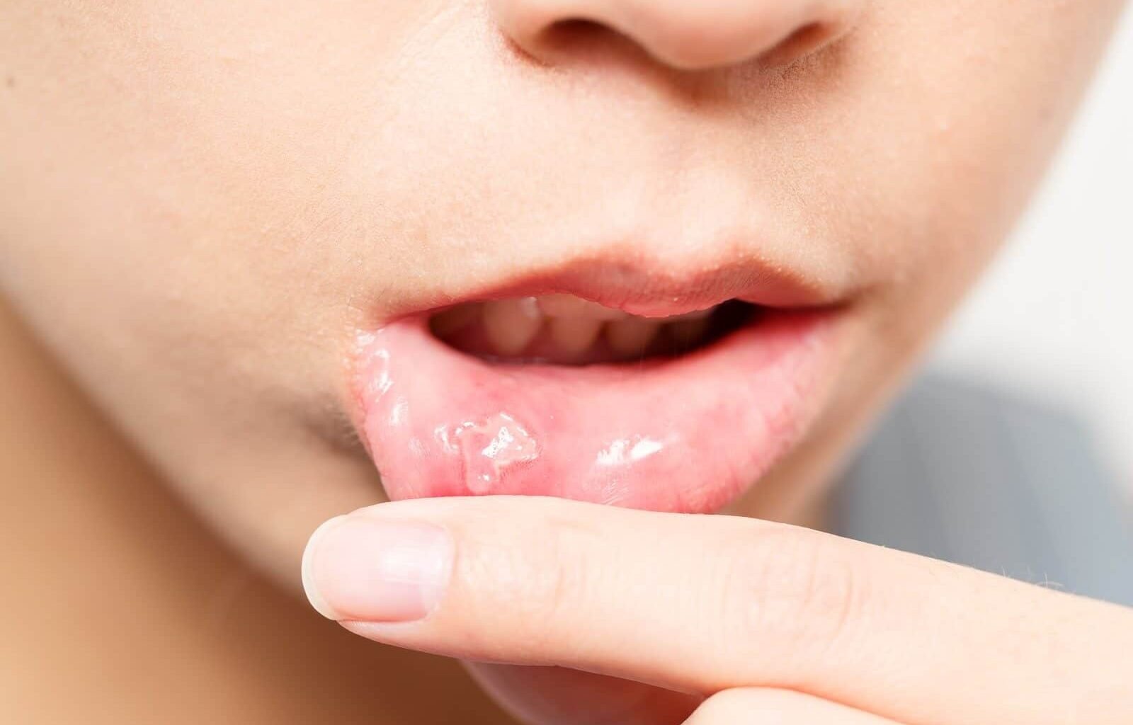 How Long Do Canker Sores Last