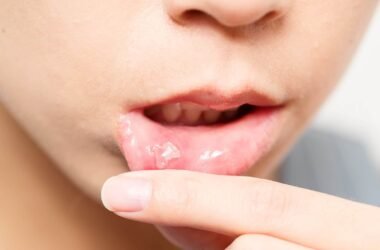 How Long Do Canker Sores Last