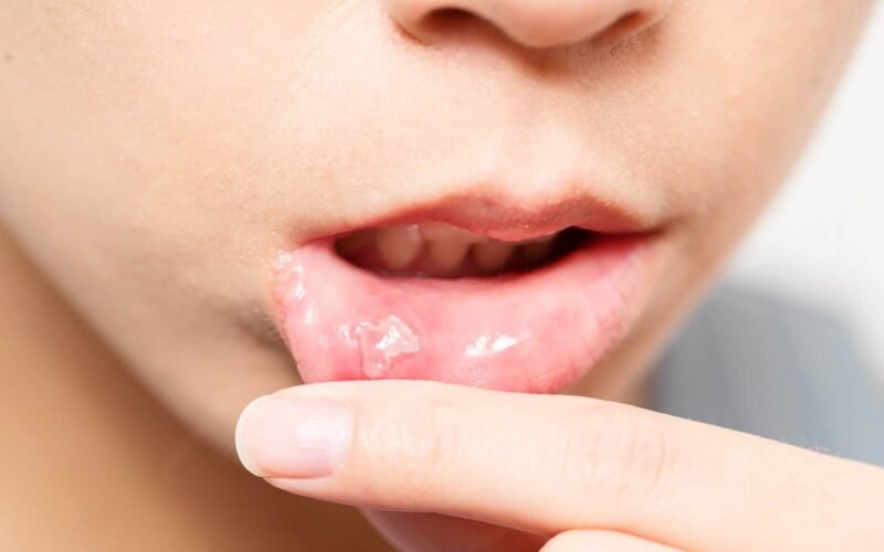 How Long Do Canker Sores Last